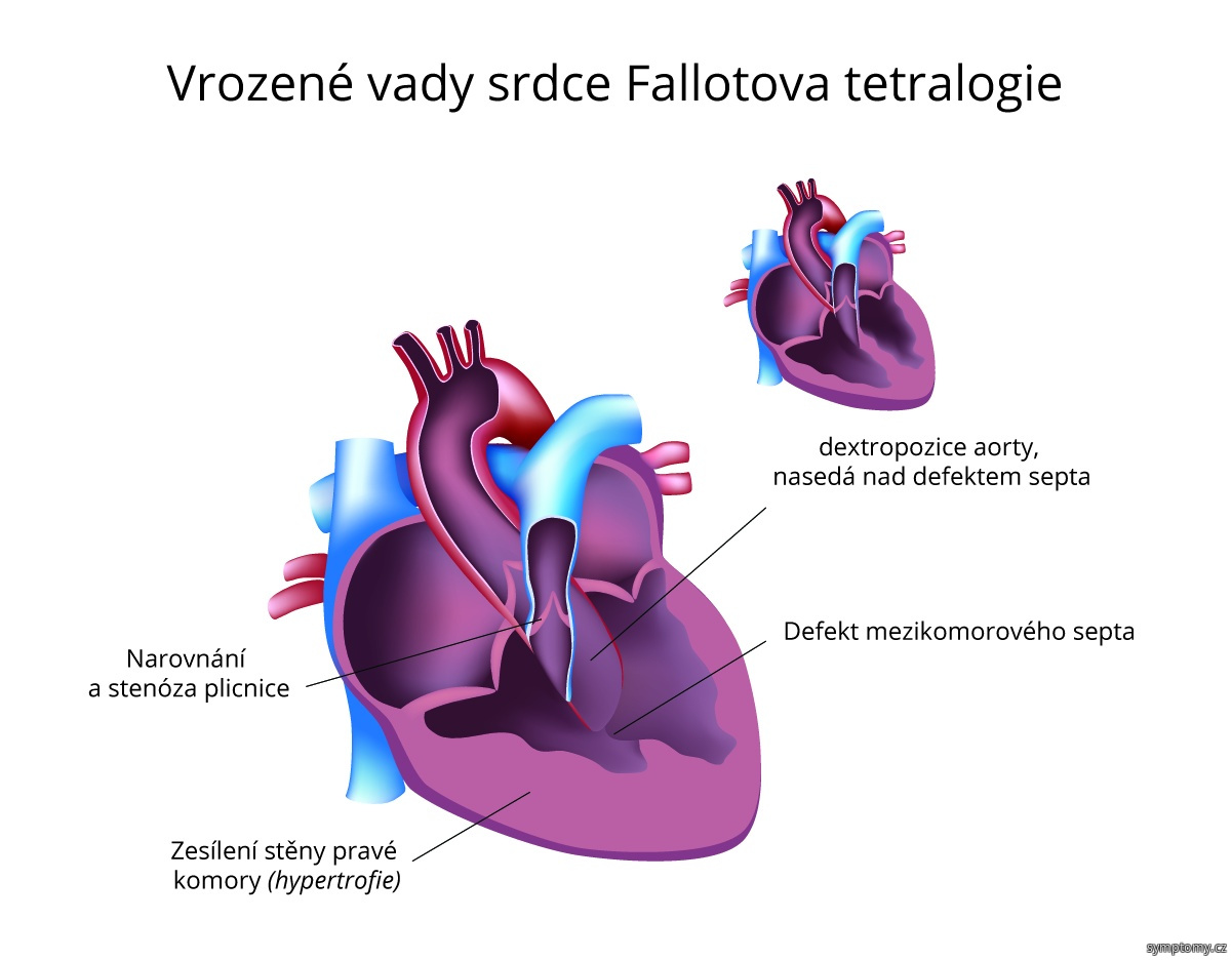 Falotova cgoroba u dospelých