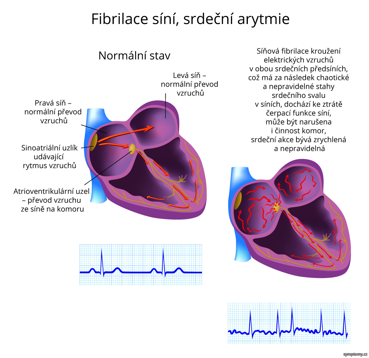 Fibrilace síní, srdeční arytmie