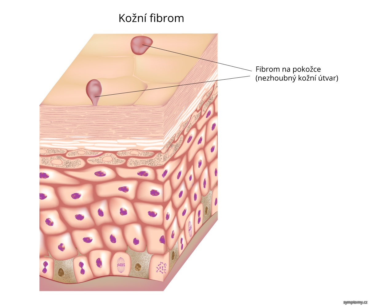 Fibrom na kůži