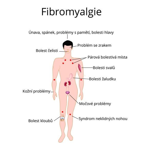 Fibromyalgie