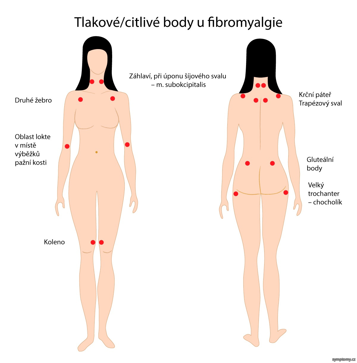 Tlakové - citlivé body u fibromyalgie