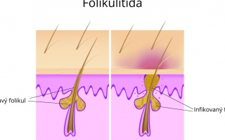 Folikulitida