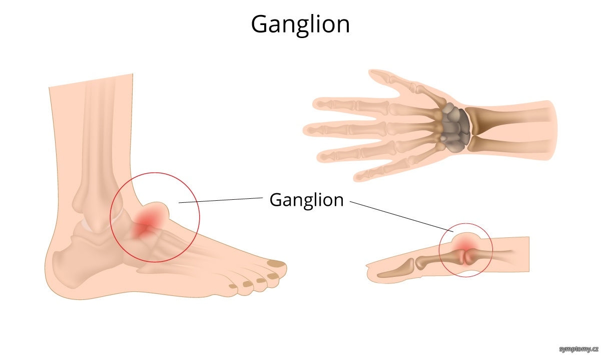 Ganglion na ruce a noze