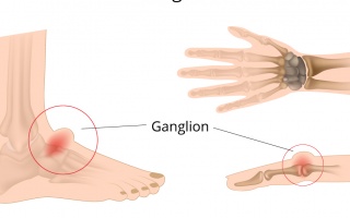 Ganglion