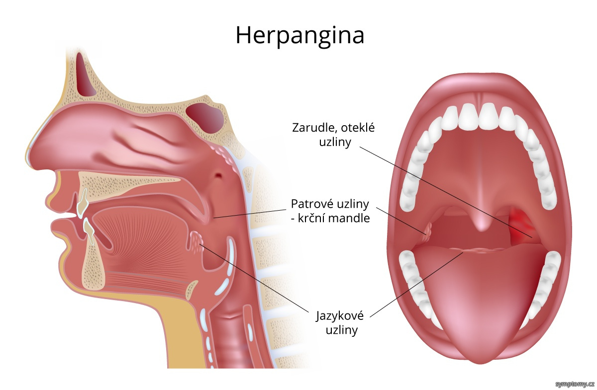Herpangina - oteklé uzliny