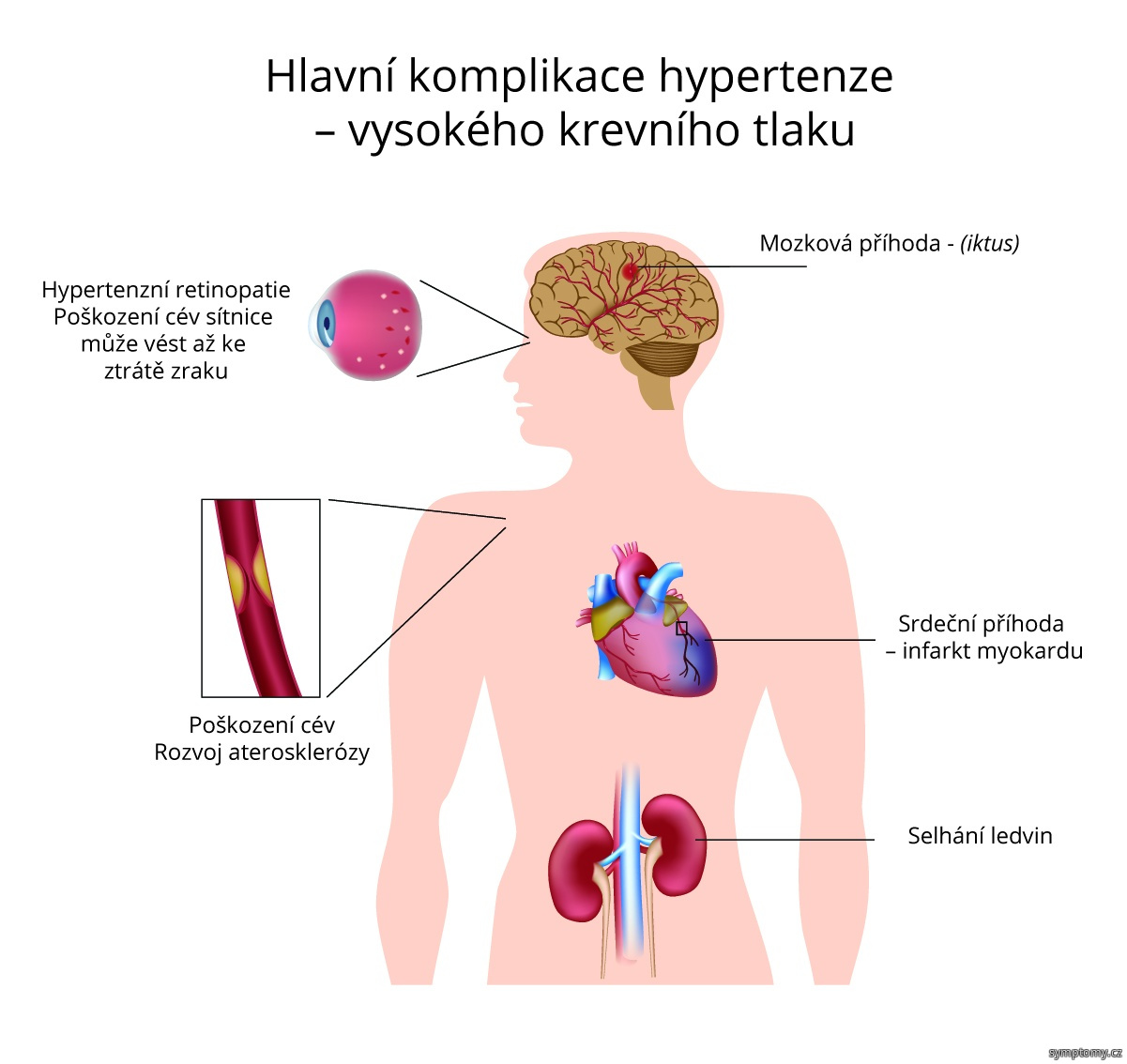 vysoký krevní tlak projevy nemoci)