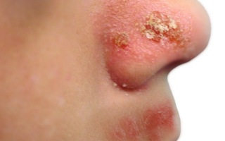 Impetigo