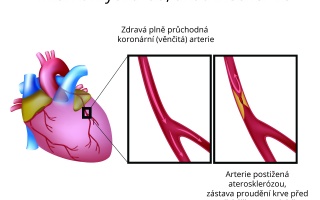 Infarkt myokardu