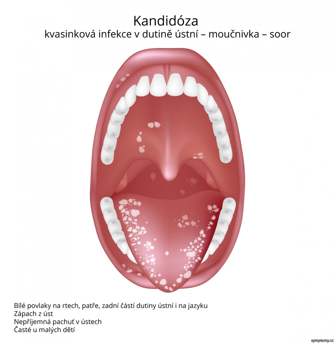 Kandidóza (kvasinková infekce v dutině ústní)