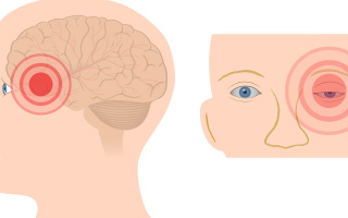 Klastrová bolest hlavy 