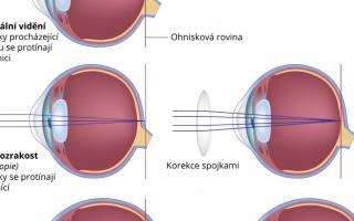 Krátkozrakost