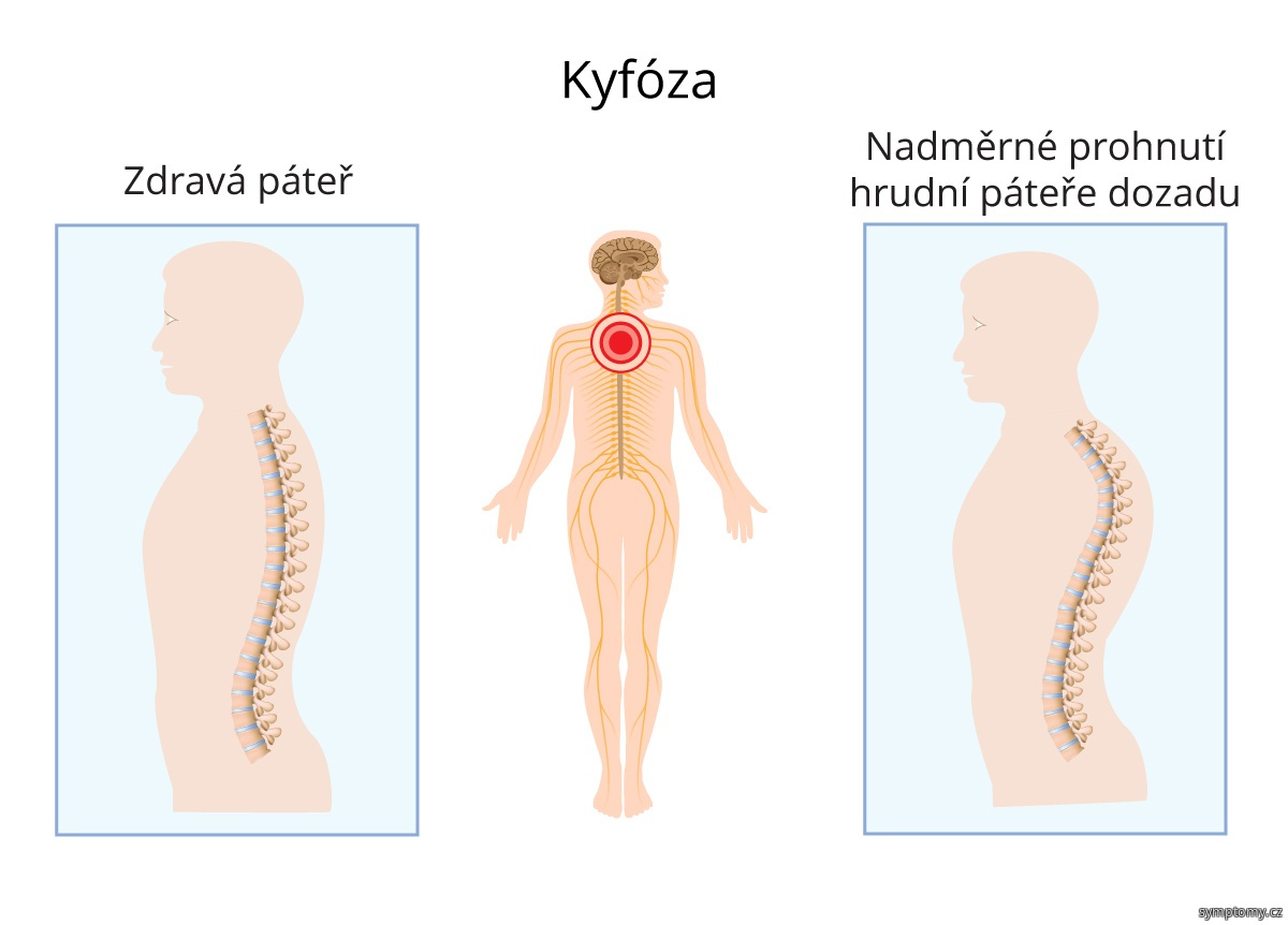 Co je to Kyfosa?