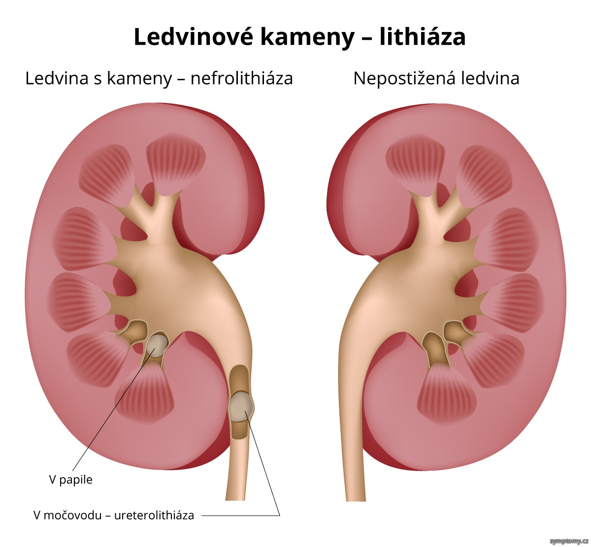 Co na kámen v močovodu?