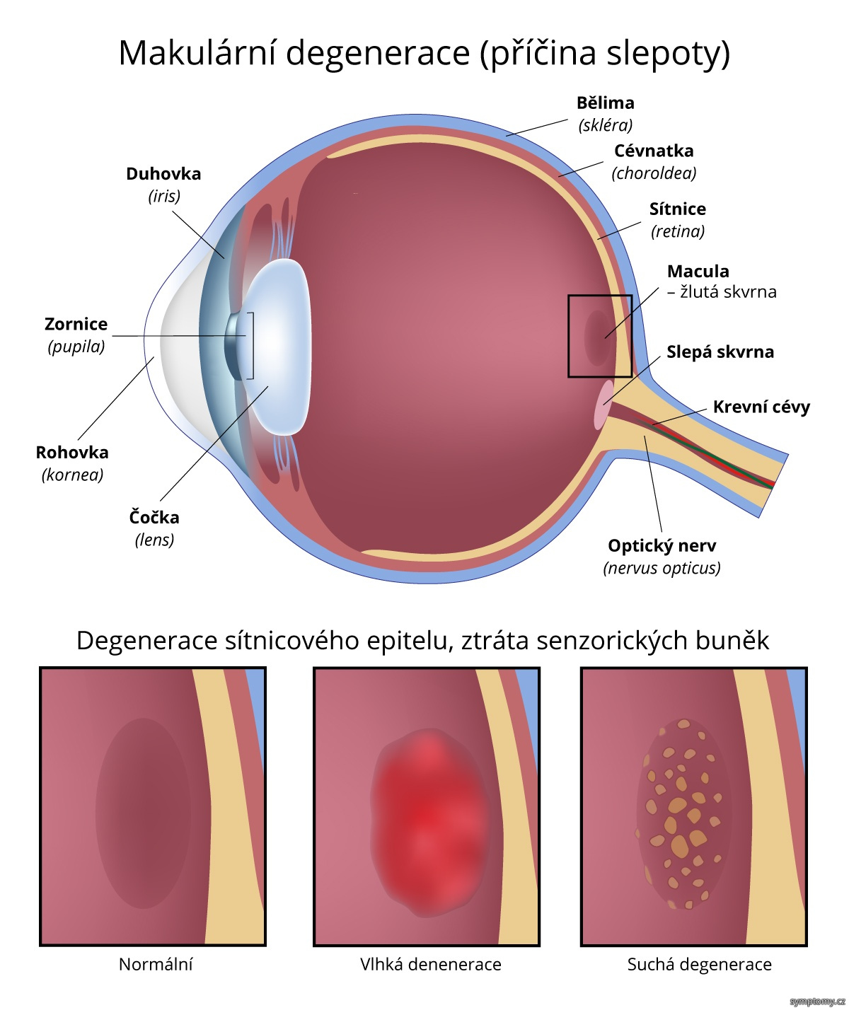 Makulární degenerace - příčina-slepoty