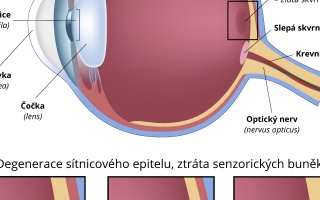 Makulární degenerace