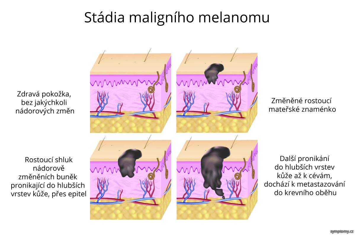 Stádia maligního melanomu