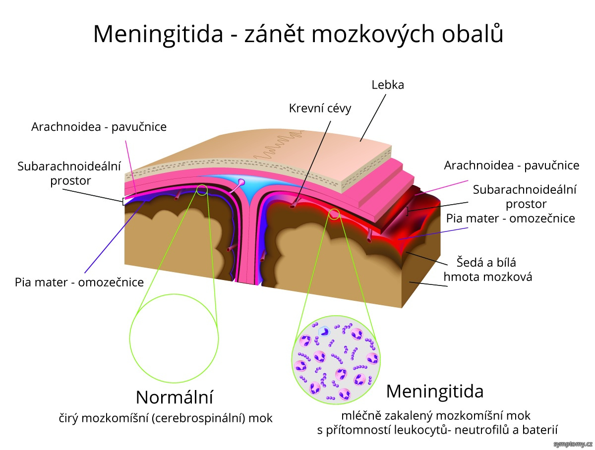 Meningitida - zánět mozkových blan