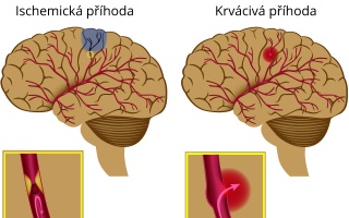 Mozková příhoda