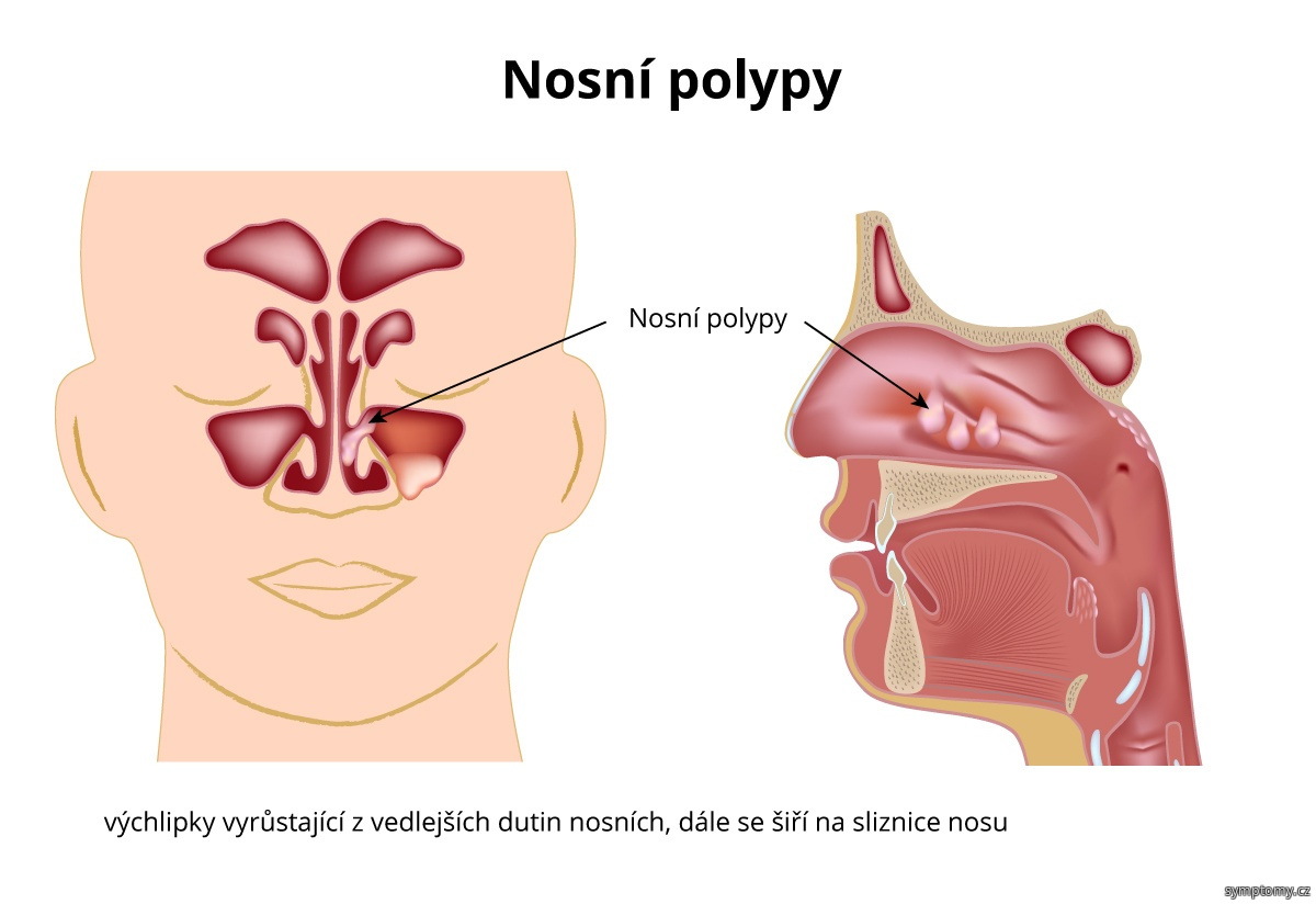 Jak vypadá polyp?