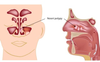 Nosní polypy