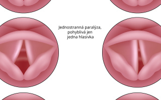 Ochrnutí hlasivek