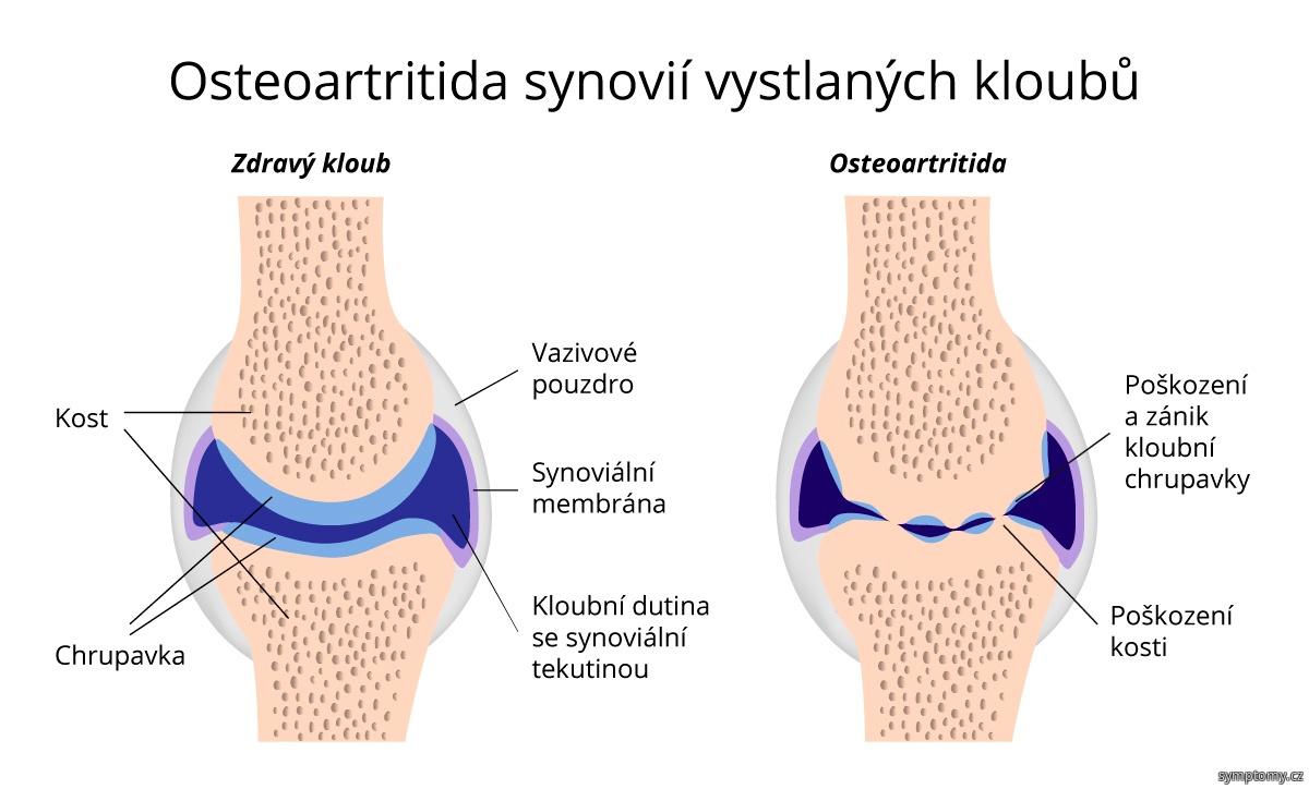 poúrazová artróza)