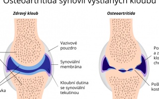 Osteoartritida