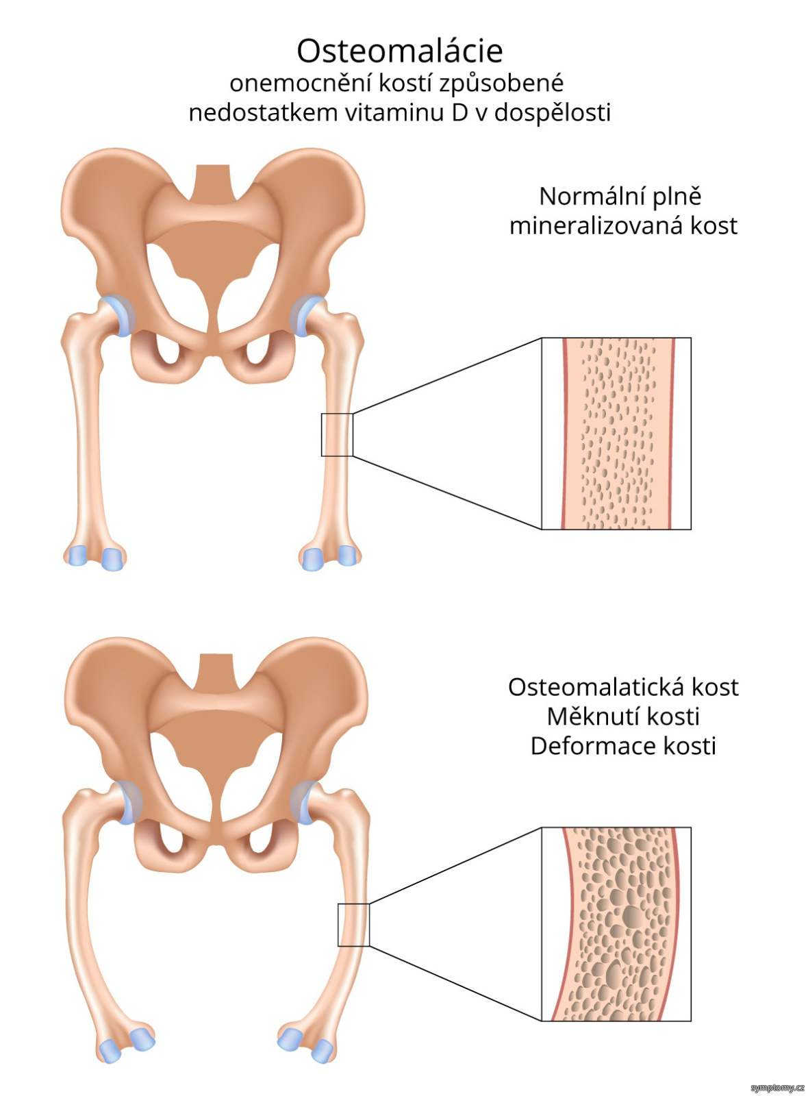Osteomalácie