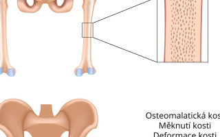 Osteomalacie