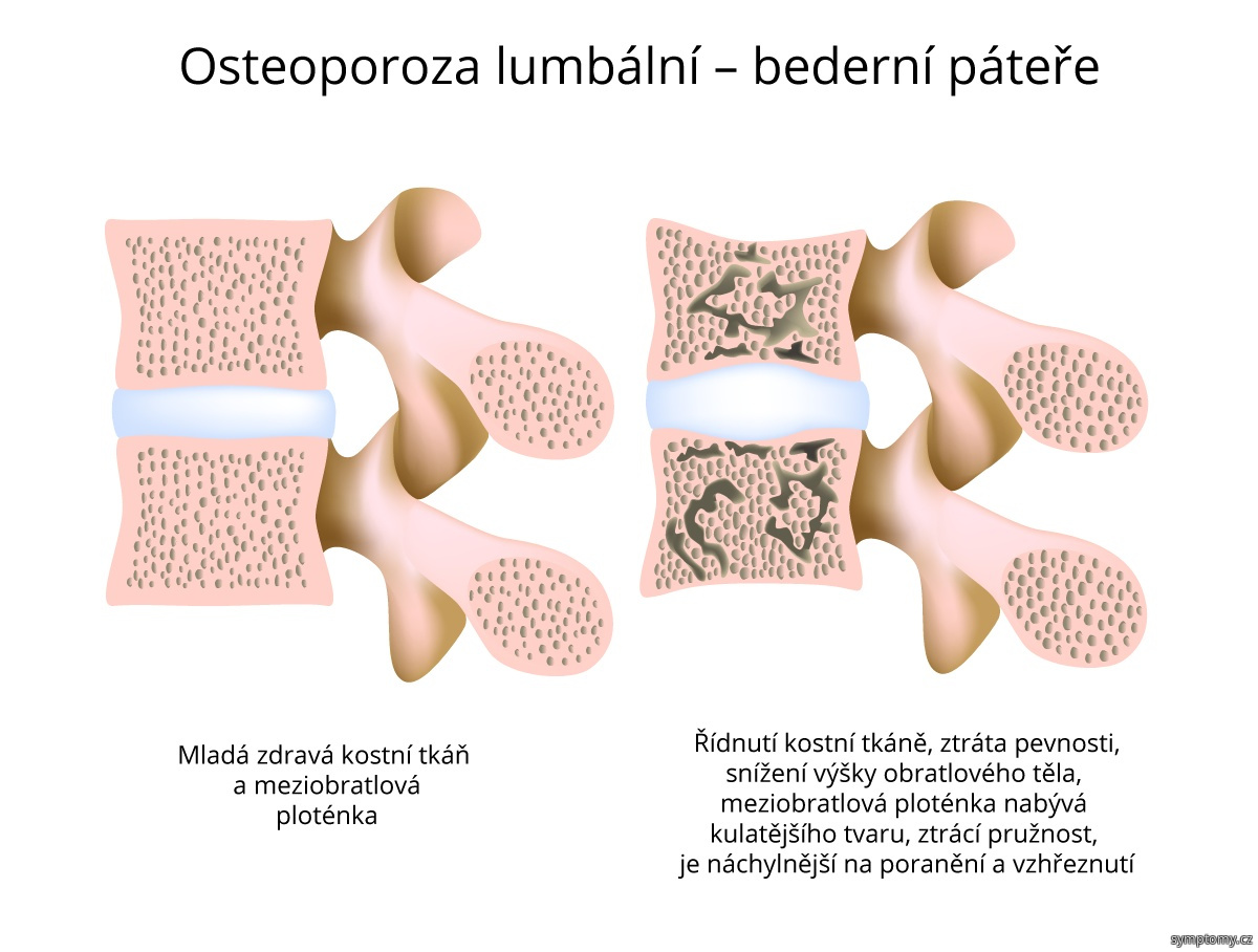 Osteoporoza lumbální - bederní páteře