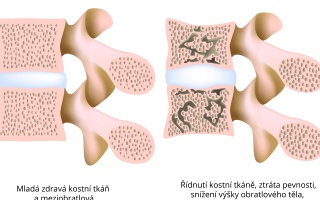 Osteoporóza bederní páteře