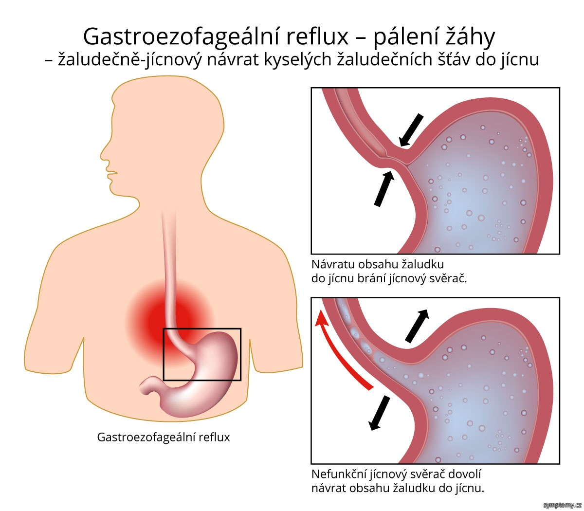 Jak se projevuje reflux?