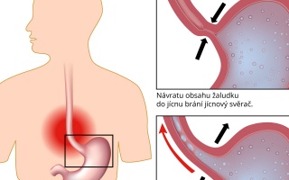 Pálení žáhy