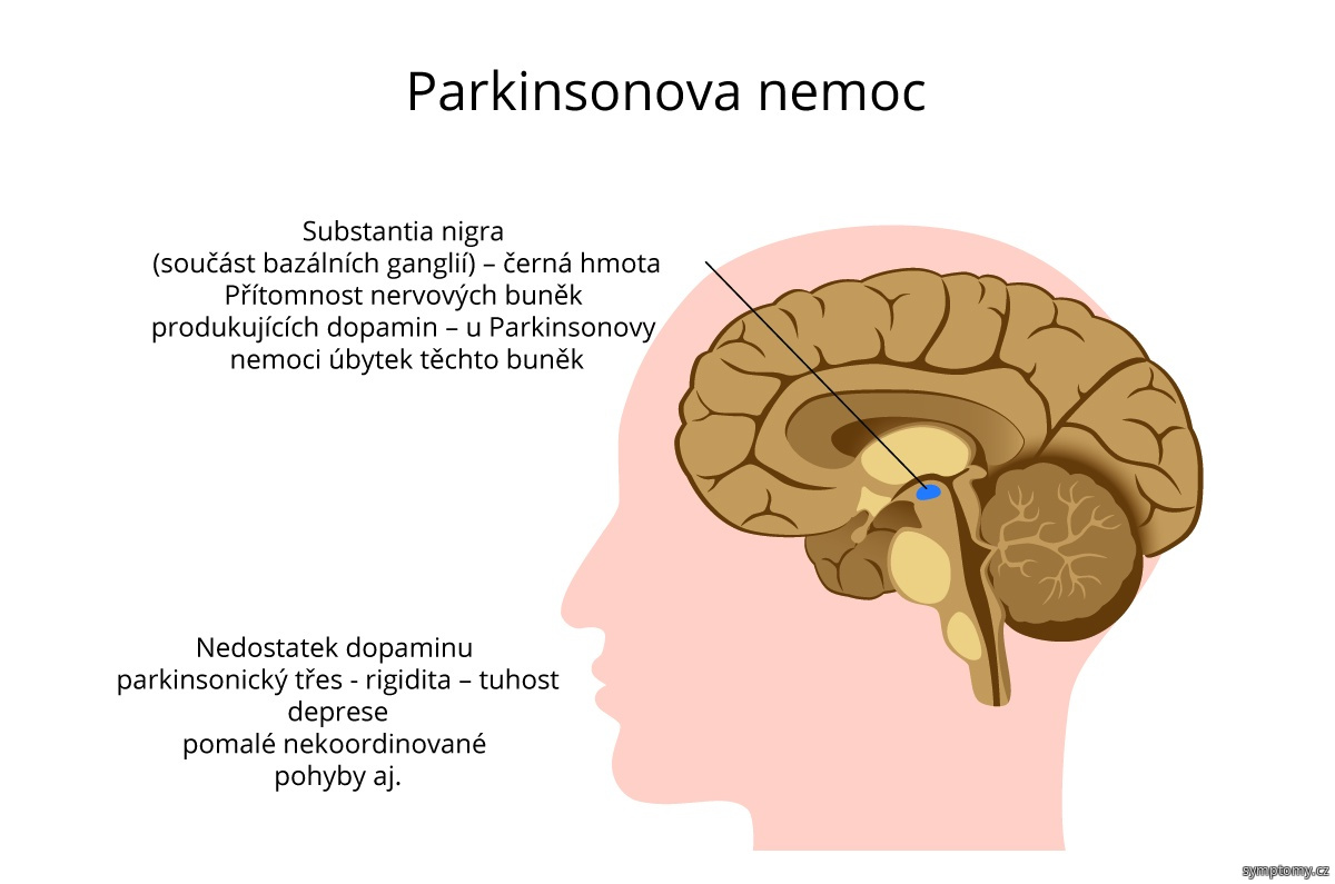Parkinsonova nemoc - Substania nigra