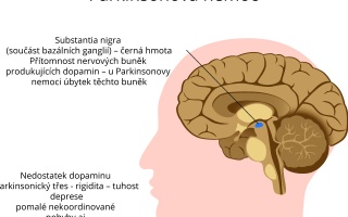 Parkinsonova nemoc