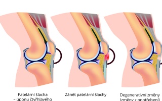 Patelární tendinitida 