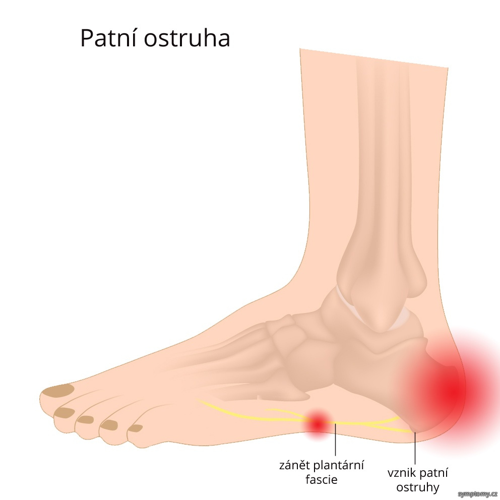 Jak se projevuje ostruha?