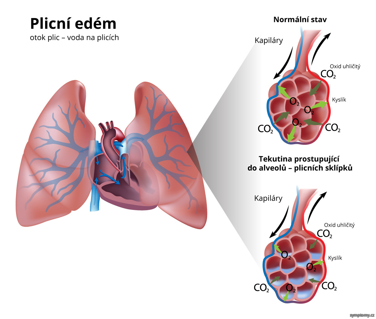 Co je plicní edém?