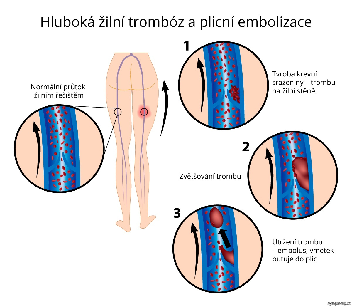 Co je příčinou plicní embolie?