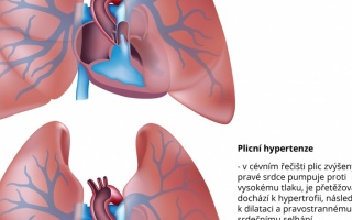 Plicní hypertenze