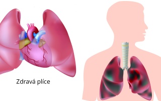 Plicní mor