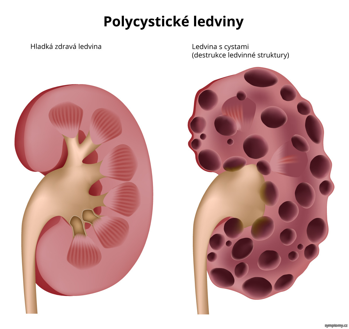 Polycystické ledviny