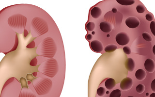 Polycystická nemoc ledvin