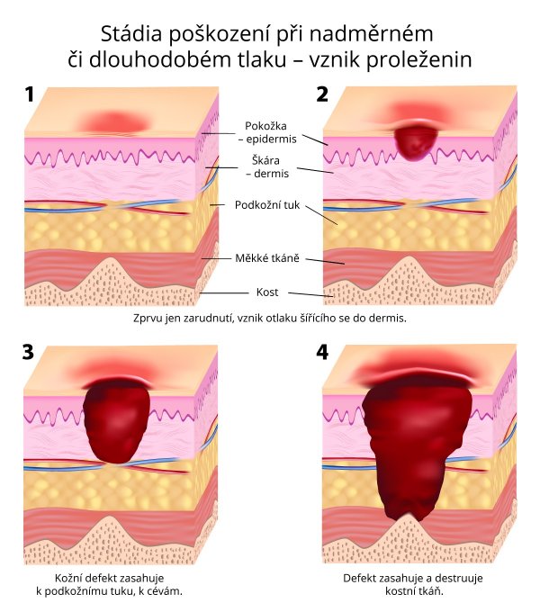 Stádia poškození při nadměrném či dlouhodobém tlaku (vznik proleženin)