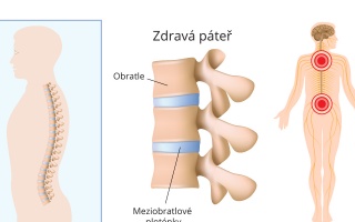 Radikulopatie