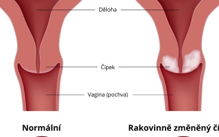 Rakovina děložního čípku