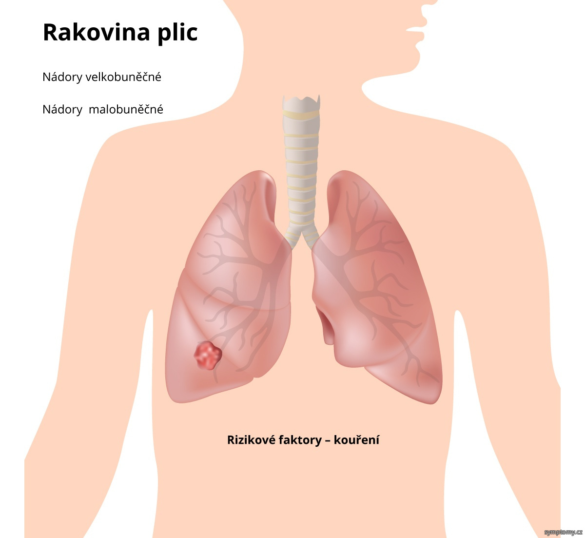 Kde bolí rakovina plic?