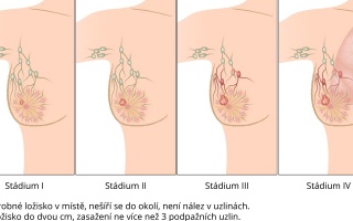 Rakovina prsu