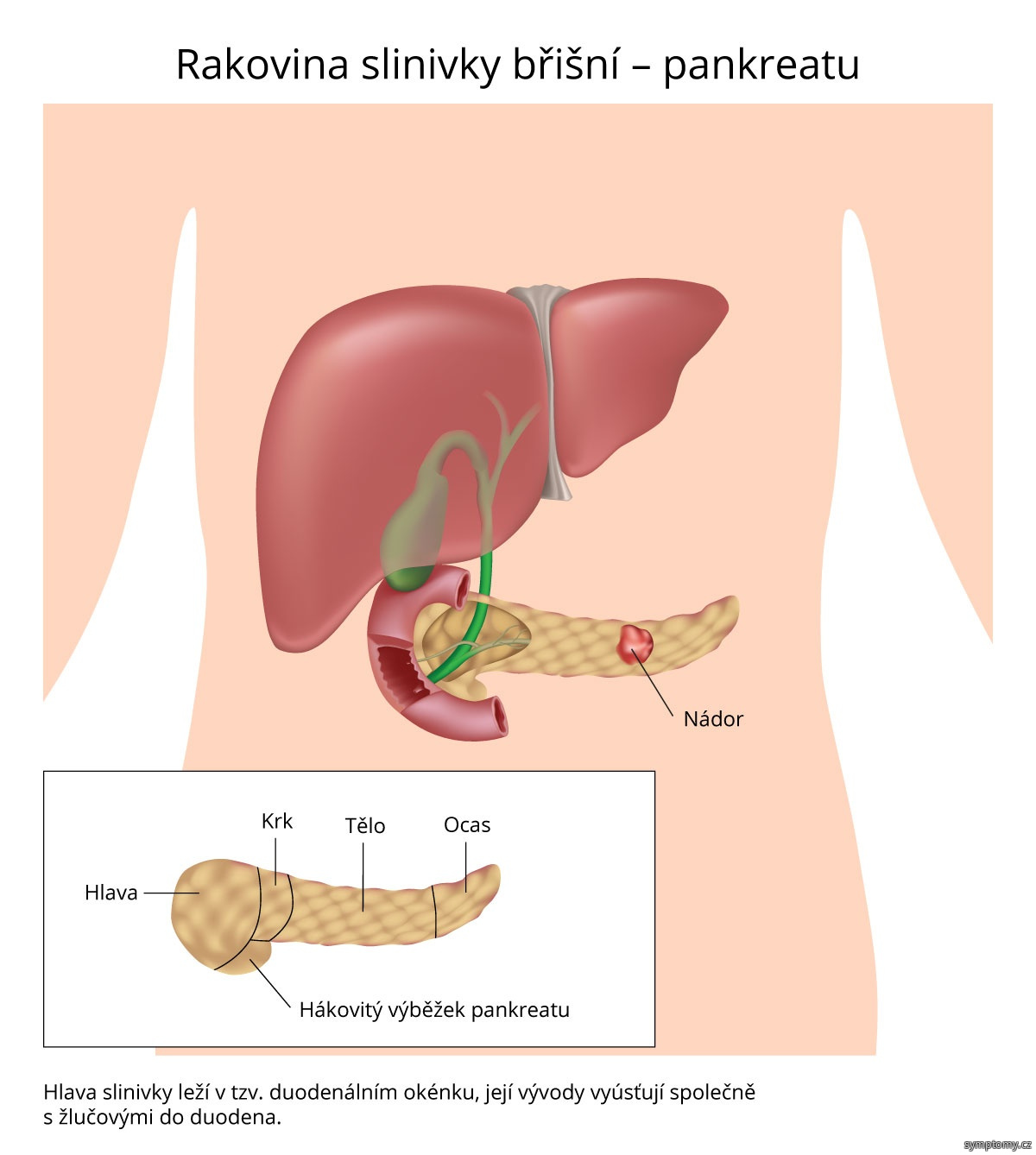 Rakovina slinivky břišní - pankreatu