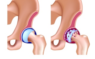 Revmatoidní artritida kyčelního kloubu